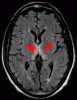 MRI Wernicke with Arrows