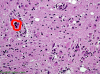 HIV encephalopathy Multinucleated Giant Cell