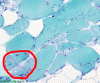 IBM trichrome with highlighted rimmed vacuoles