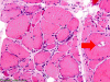 Inclusion Body Myositis H&E 200 with arrow