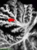 Alcoholic Cerebellar Degeneration with arrow