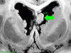 Tuberous Sclerosis SEGA and Nodules with arrow