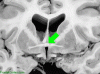 Anterior Commissure Coronal with arrow