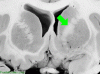 Basal Ganglia Coronal Close Up - Internal Capsule