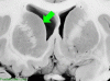 Basal Ganglia Coronal Close- Caudate