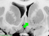 Basal Ganglia Coronal Close - Nuc Accumbens