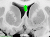 Basal Ganglia Coronal Close - CC