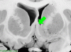 Basal Ganglia Coronal Close - Fornix