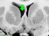 Basal Ganglia Coronal Close - Lat Ventricle