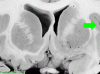 Basal Ganglia Coronal Close - Insula