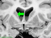 Anterior Commissure Coronal - Caudate