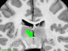 Posterior Commissure Coronal with arrow