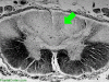 Freidreich Ataxia Spinal Cord - Loss of Dorsal Columns