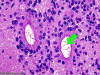 True ependymal rosettes x400 with arrow