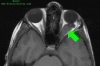 Optic Pathway Glioma with arrow