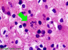 TLDL creutzfeldt cell with arrow