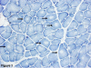 NADH stained skeletal muscle from a patient with CCD.