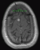 Neuroneurocysticercosis