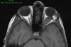 Optic Pathway Glioma