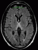 Wernicke Encephalopathy