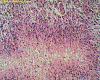 Glioblastoma multiforme demonstrating pseudopalisading Necrosis H&E stain x 400