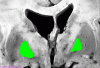 Bilateral Pallidal Necrosis Highlighted