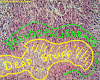 Pseudopalisading Necrosis Explained