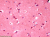 Alzheimer type 2 astrocytosis, H&E stain x 400