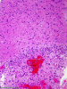 Tumefactive demyelination, brain/lesion interface, high power H&E stain