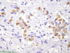 Tumefactive demyelination, immunohistochemical staining for CD68