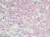 Clear Cell Meningioma, high power H&E stained section