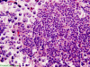 Germinoma, H&E stain x 400