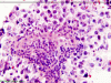 Germinoma, H&E stain x 400