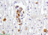 HIV encephalopathy, p24 immunohistochemistry x 200.