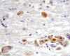 HIV encephalopathy, P24 immunohistochemical staining for HIV x 400