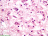 Kearns-Sayre syndrome, high power H&E stained section of substantia nigra