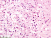 Kearns-Sayre syndrome, H&E section of substantia nigra x 200