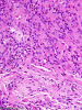 Meningioma invading brain, H&E stain.