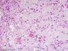 Metaplastic meningioma, myxoid type