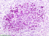 Neonatal candidiasis, PAS stain x 200