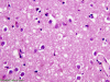 Sporadic Jakob-Creutzfeldt disease, corpus striatal, H&E stain x 200