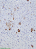 Alzheimer disease, occipital neocortex, immunohistochemical staining for beta amyloid