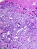 Oligodendroglioma, macrocalcifications, H&E stain x 40.