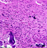 Oligodendroglioma, microcalcifications, H&E stain x 200