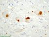 Pick Bodies, Tau Stain 400x Locus Ceruleus