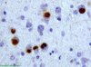 Pick Bodies, Tau Stain