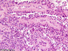 Papillary meningioma, high power H&E stained section.