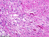 Pilocytic astrocytoma, H&E stain x 200