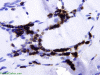 Polymyositis, CD3 immunohistochemical staining x600