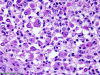 Rhabdoid Meningioma, H&E stained section